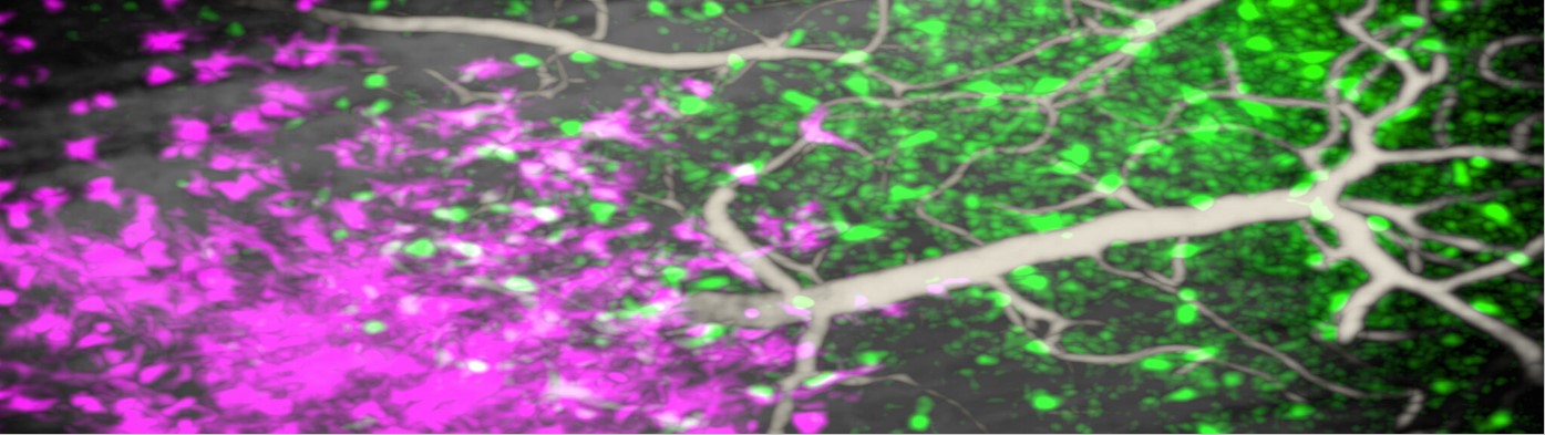 glioblastom immunzellen unterm mikroskop 1500x400px